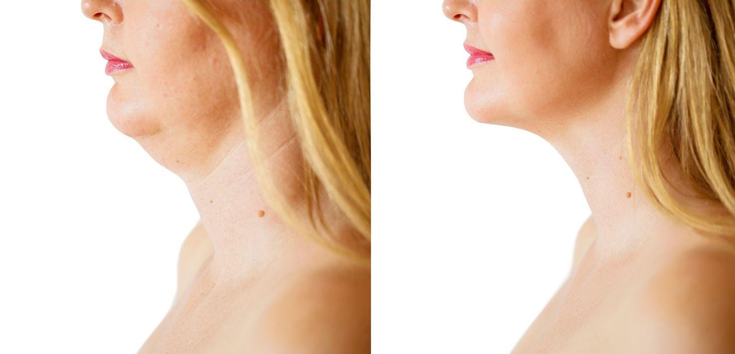 Antes: Mulher com pescoço contendo gordura e depois, pescoço sem gosrduras