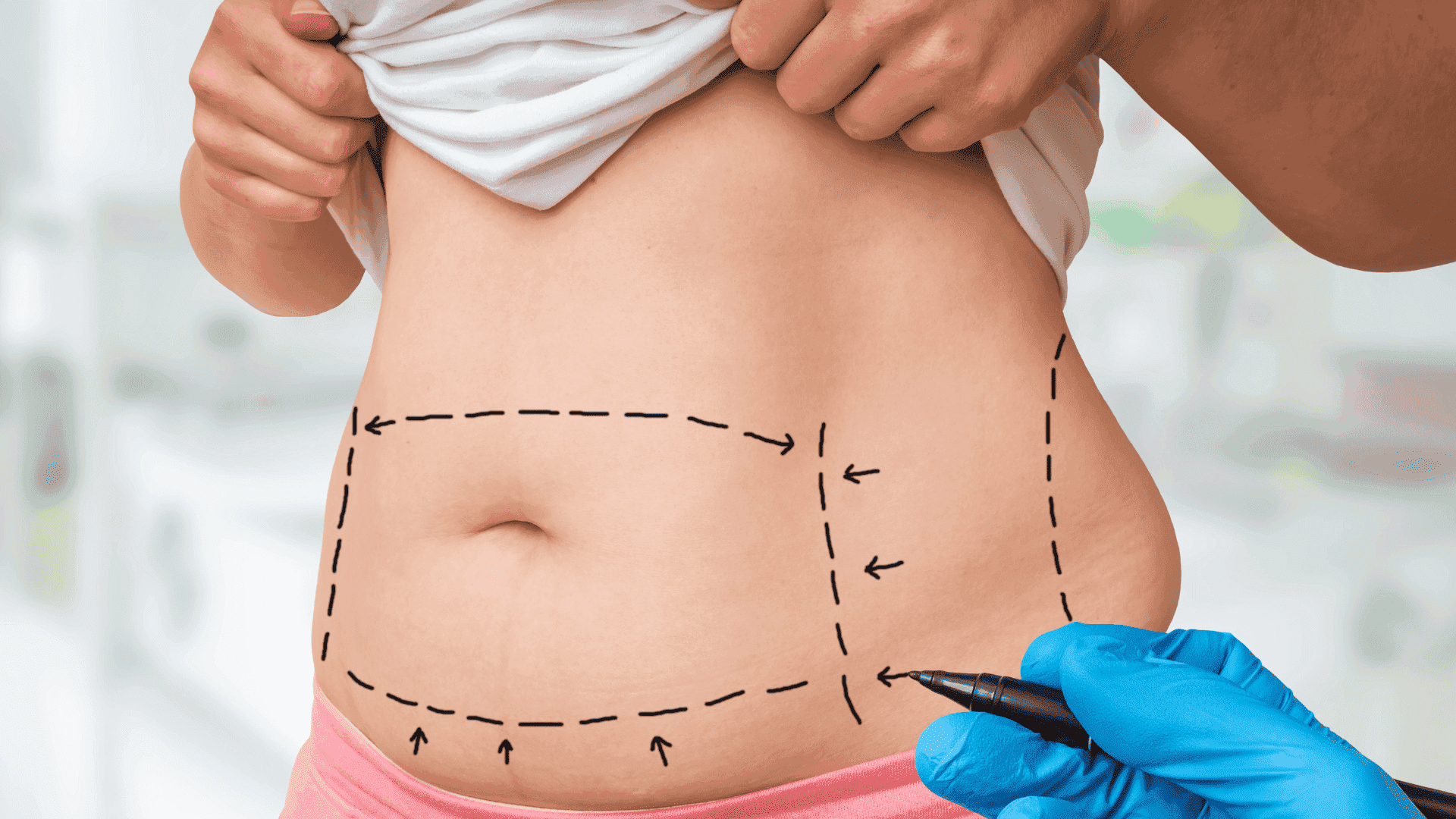 Marcação das áreas para serem lipoaspiradas durante uma lipoaspiração