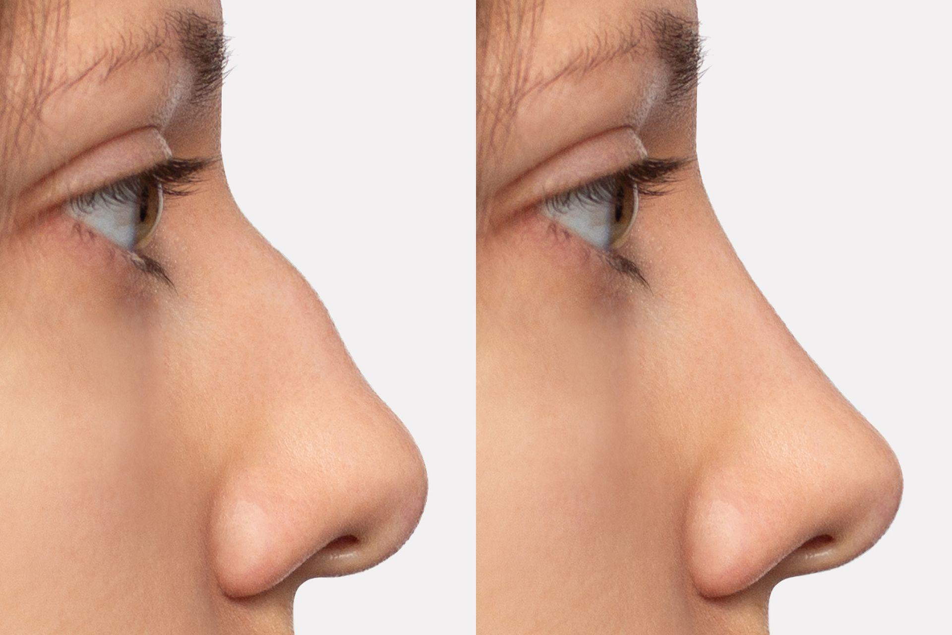 rinoplastia antes e depois, com redução do dorso nasal