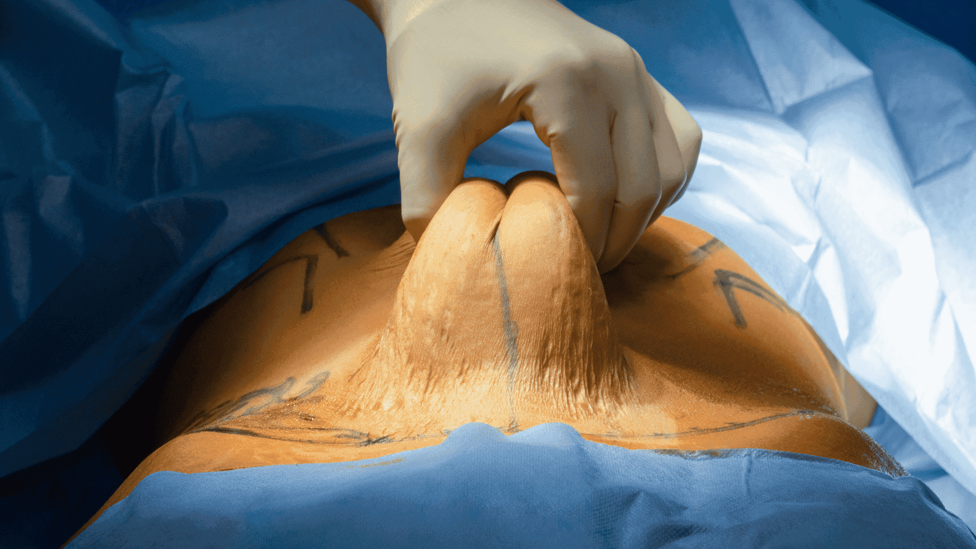 abdome durante a cirurgia de abdominoplastia