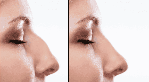 Side-by-side comparison of a woman's nose before and after cosmetic surgery.