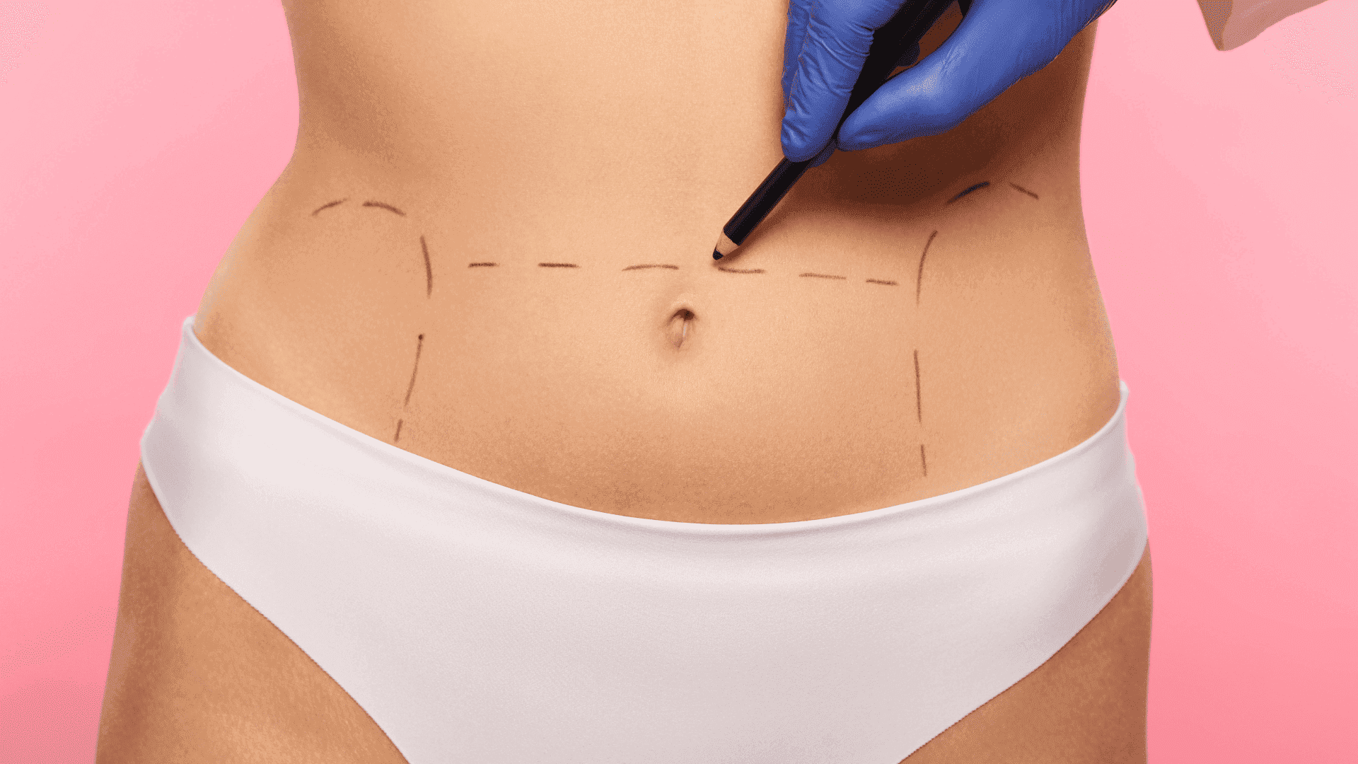 Close-up of midriff with surgical markings, blue-gloved hand holding marker.