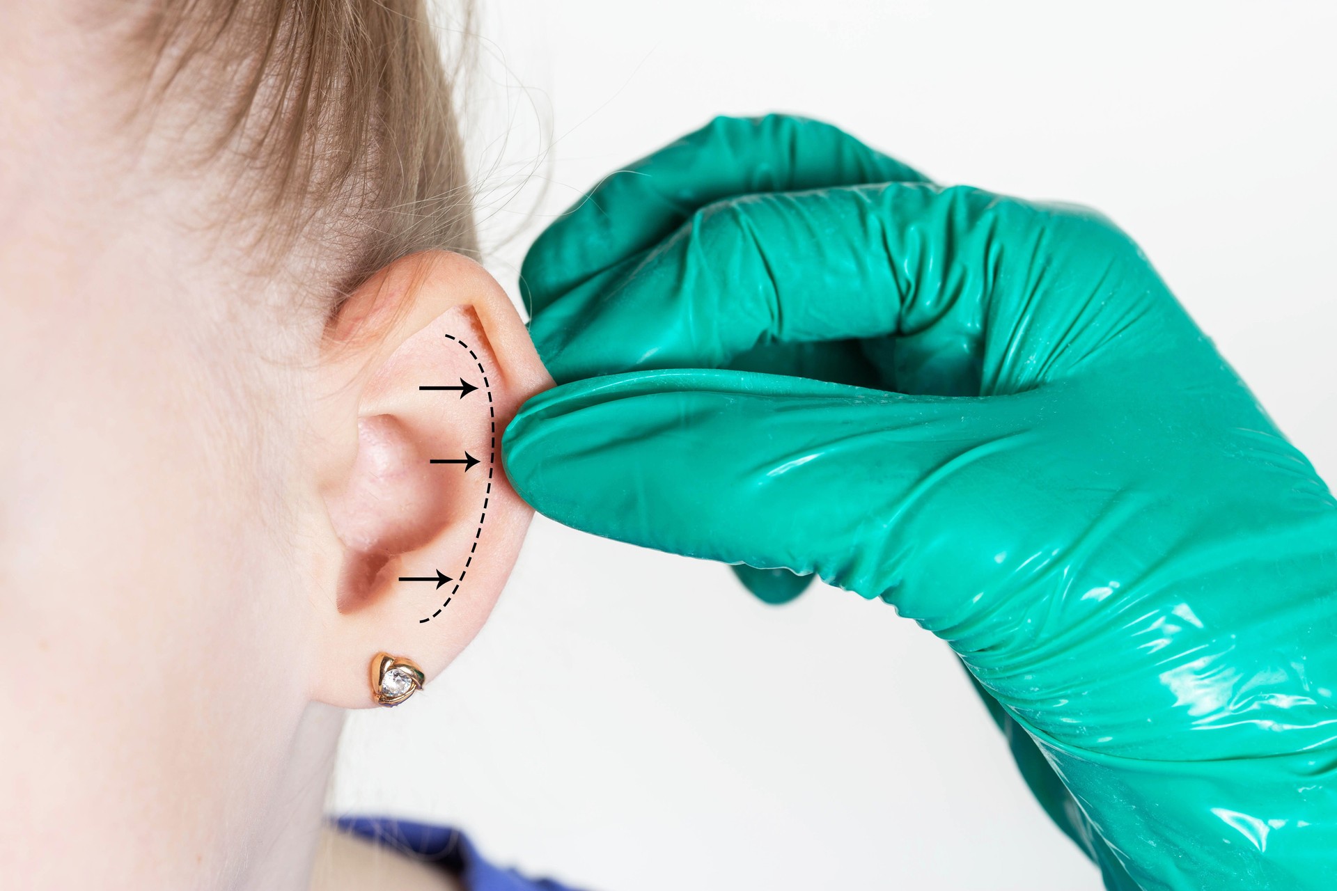 A mão de um médico cirurgião plástico segura a orelha da menina na qual os marcadores são marcados para uma operação cirúrgica. Otoplastia em crianças. Copiar espaço para texto, close-up