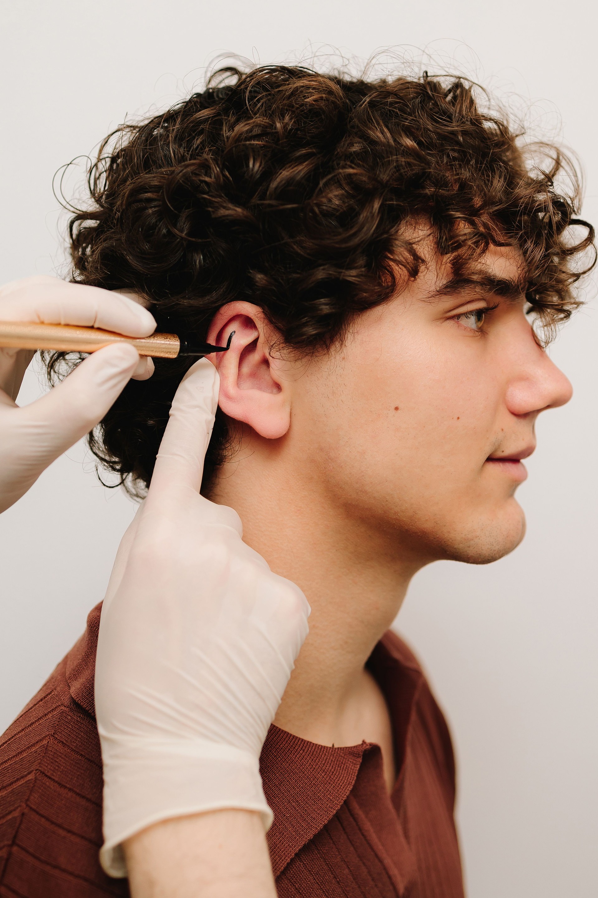 Cirurgião traçando linhas de marcação antes do cirurgião de Otoplastia nas orelhas. Aplicação de marcação no pavilhão auricular para corrigir a forma das orelhas. Marcação de otoplastia na orelha.